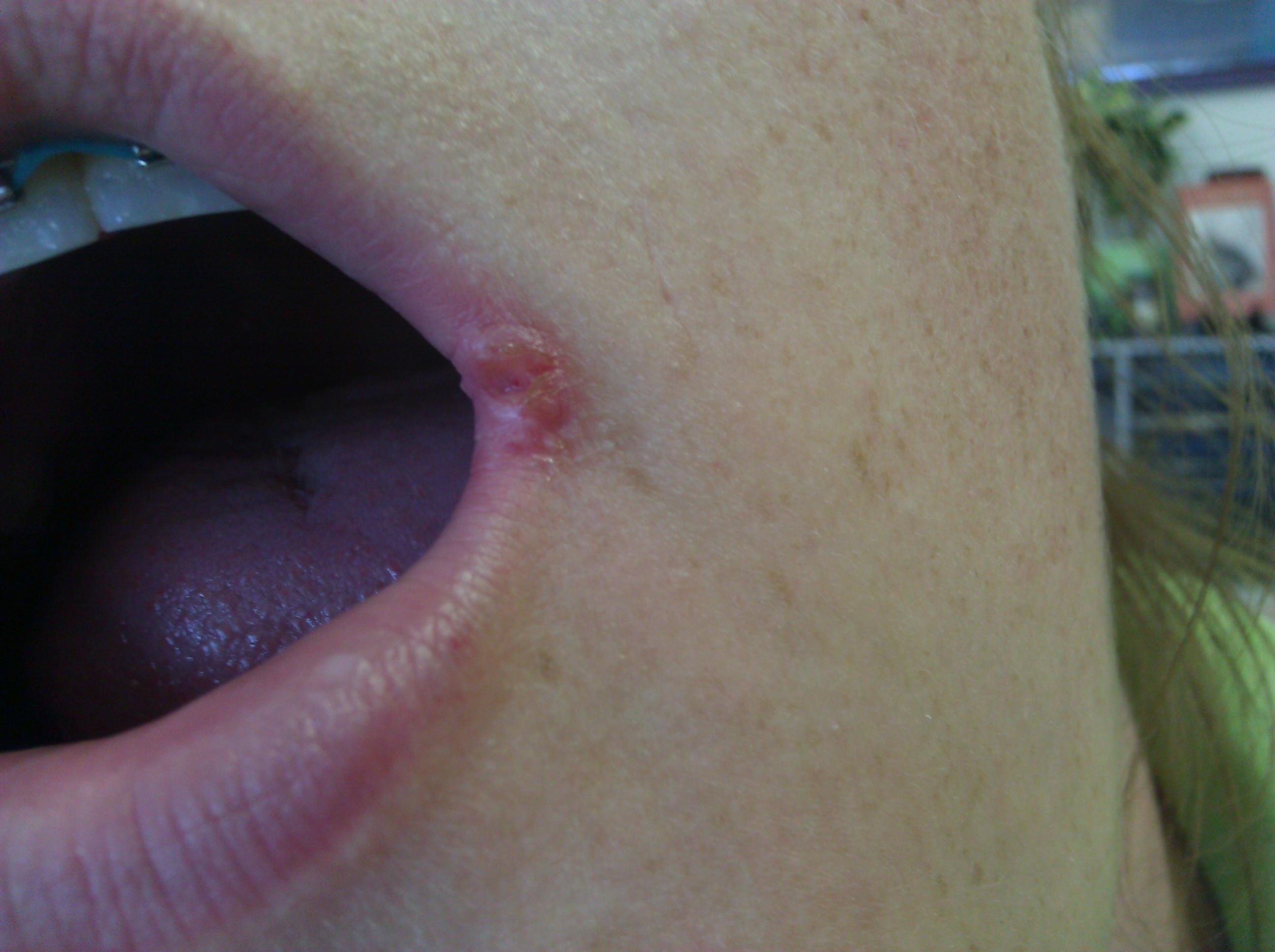 Cut On Corner Of Mouth 5